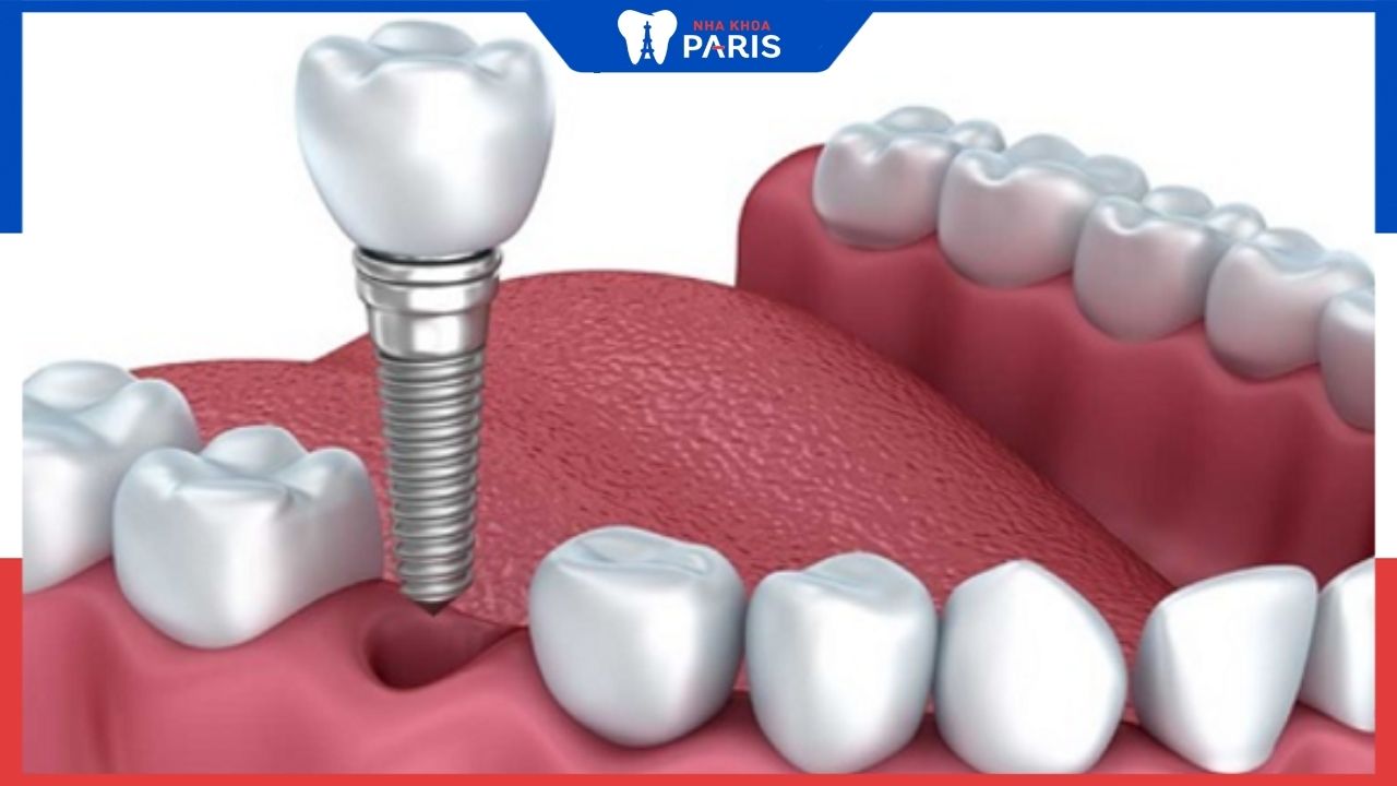 Thời gian làm răng implant bao lâu? 3 cách rút ngắn thời gian hiệu quả